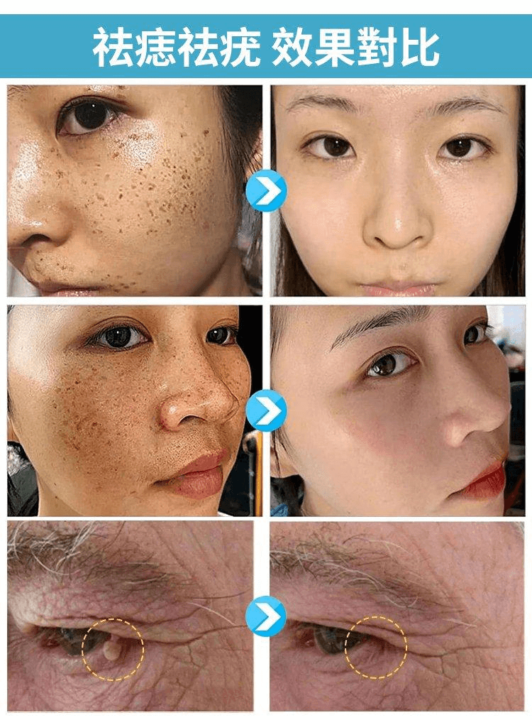 黃輔堂點痣膏