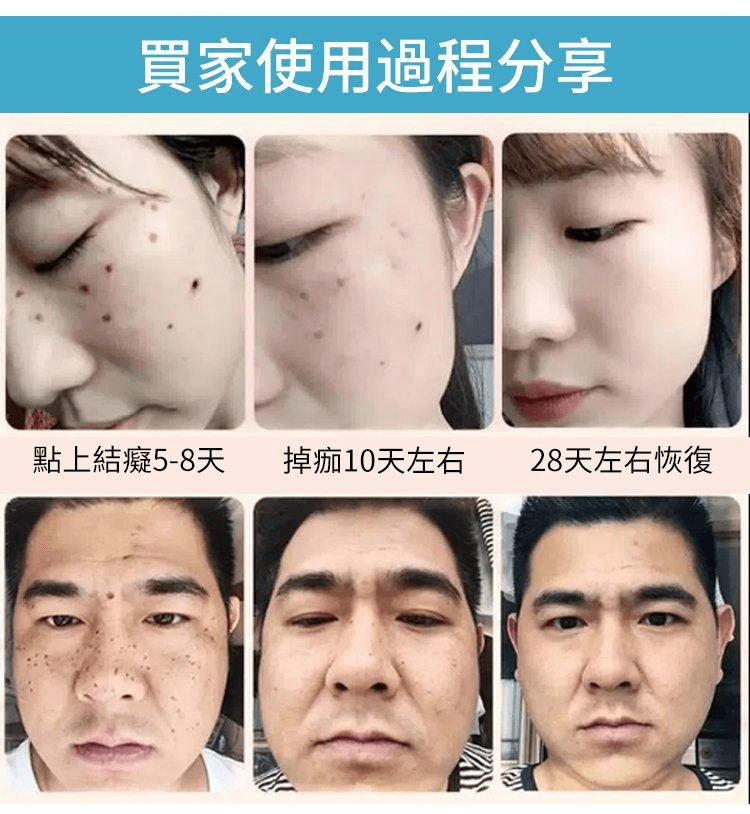 黃輔堂點痣膏